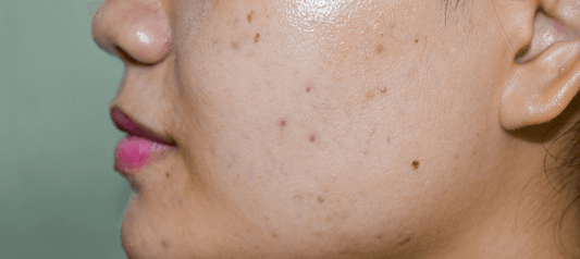 Are Your Dark Spots Actually Getting Worse This Summer? Here’s Why