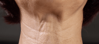 How To Fix Crepey Skin Fast