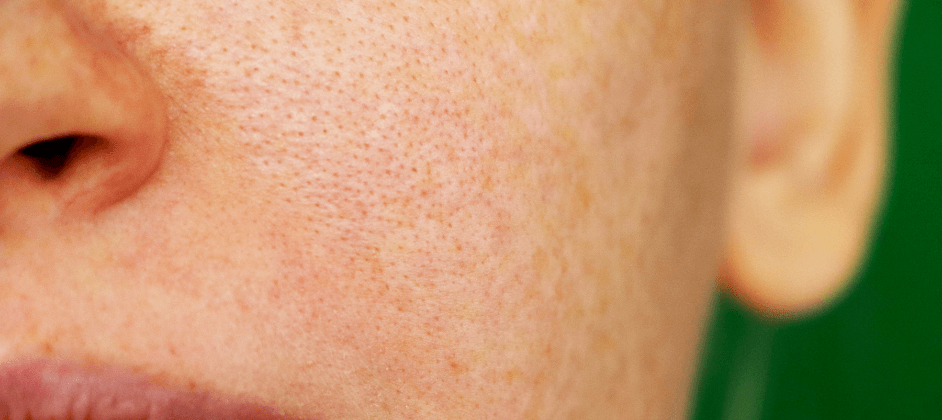 How To Avoid Enlarged Pores And Feel More Confident About Your Skin's Texture