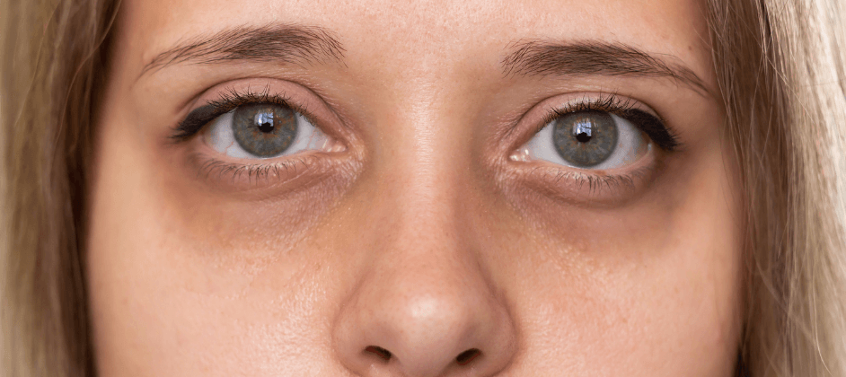 Myth: Dark Circles Are Caused By Lack Of Sleep - Is It True?