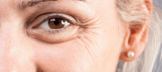 What to Do If You’re Seeing New Wrinkles Around Your Eyes