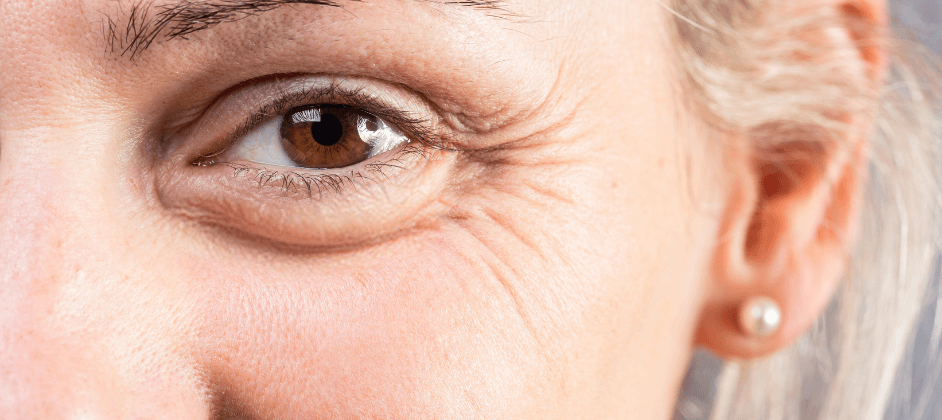 What to Do If You’re Seeing New Wrinkles Around Your Eyes