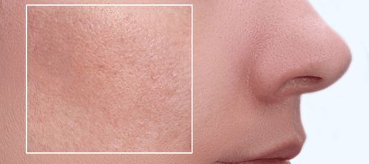 How to Keep Your Pores Clear (Without Stripping Your Skin)