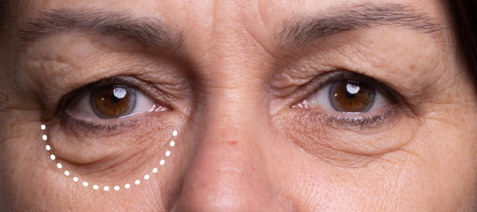 Three Types Of Eye Wrinkles That Need Your Attention ASAP!