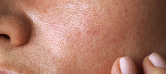 If Your Skin Type Is Oily, Make Sure You Follow These Tips
