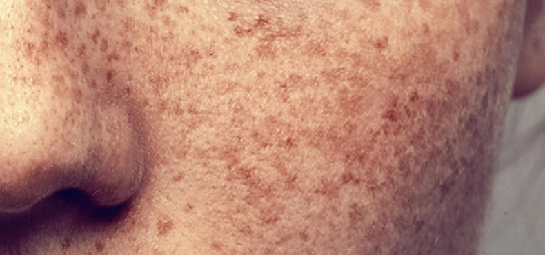 Here’s The Easiest Way To Get Rid of Unwanted Sun Spots